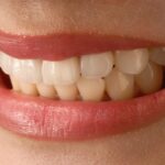 Entdecke, welche Zahnveneers am besten für dich sind