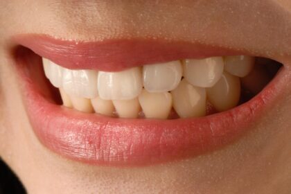 Entdecke, welche Zahnveneers am besten für dich sind